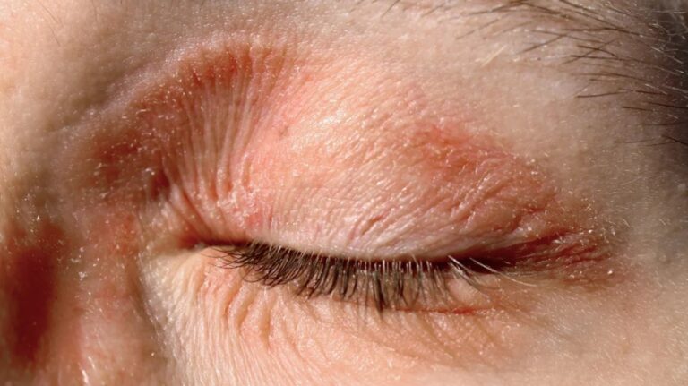 Eyelid Dermatitis Care Tips: Soothing Solutions for Sensitive Skin